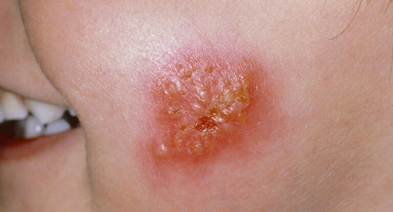 Tomato like blisters due to viral infection in children in Kerala