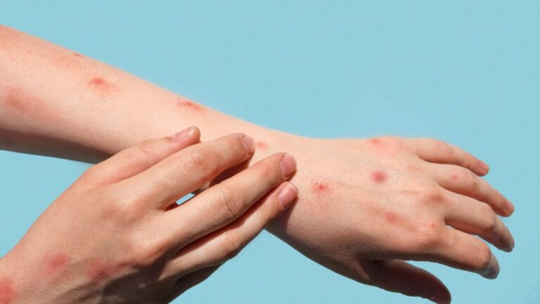 India reports its second Monkeypox case